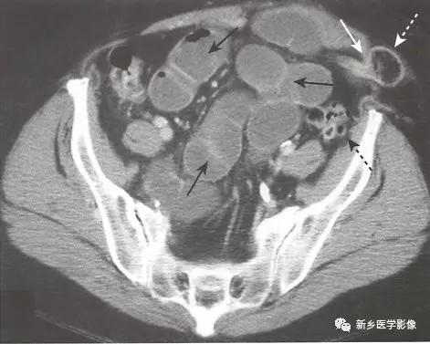 辨识肠梗阻,肠梗阻死亡前兆