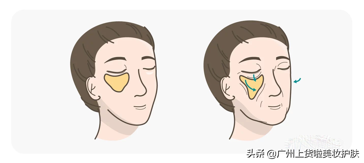 法令纹的种类和改善方法有哪些,法令纹比较深最有效的办法