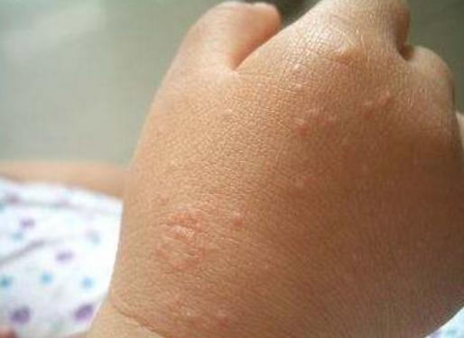 下身有几只阴虱怎么办,内裤上出现虱子卵怎么办