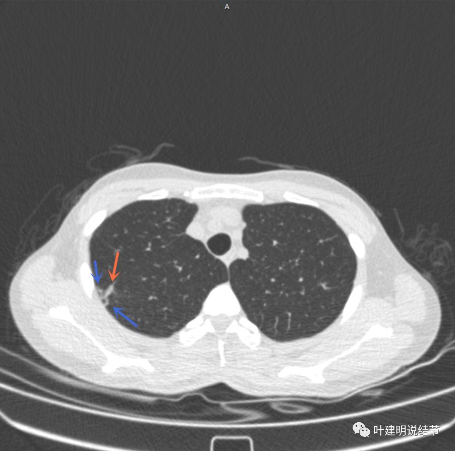 临床诊断孤立性肺结节,空洞型结节一般是什么性质