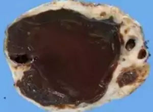 肚子里能长“巧克力”？没有骗人，是真的！