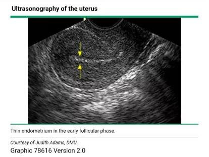子宫壁薄医生不建议怀孕怎么办,子宫内膜薄可以怀疑吗