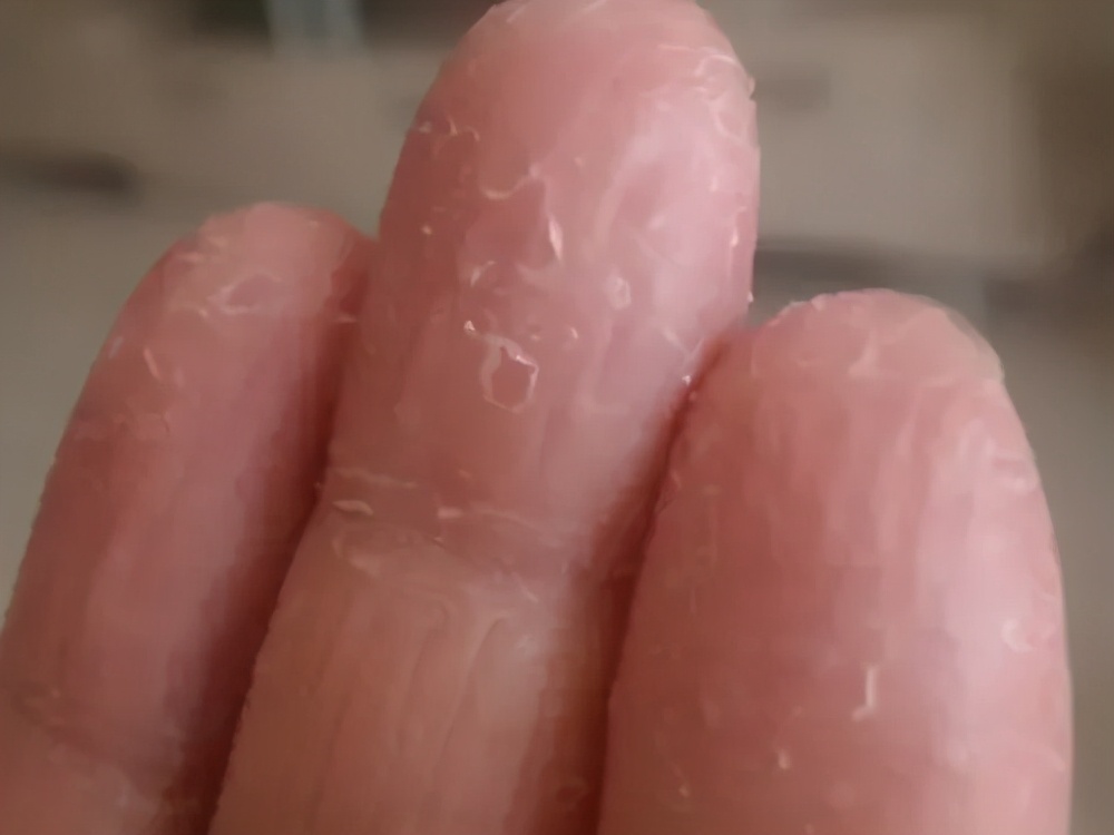 痒痒痒!身上出现这种小水疱,千万别戳破