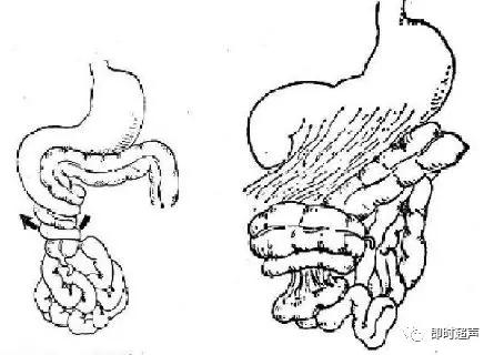 小儿消化道急症超声