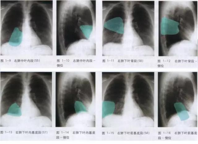 收藏：详细的胸部X线解剖，最基础最实用