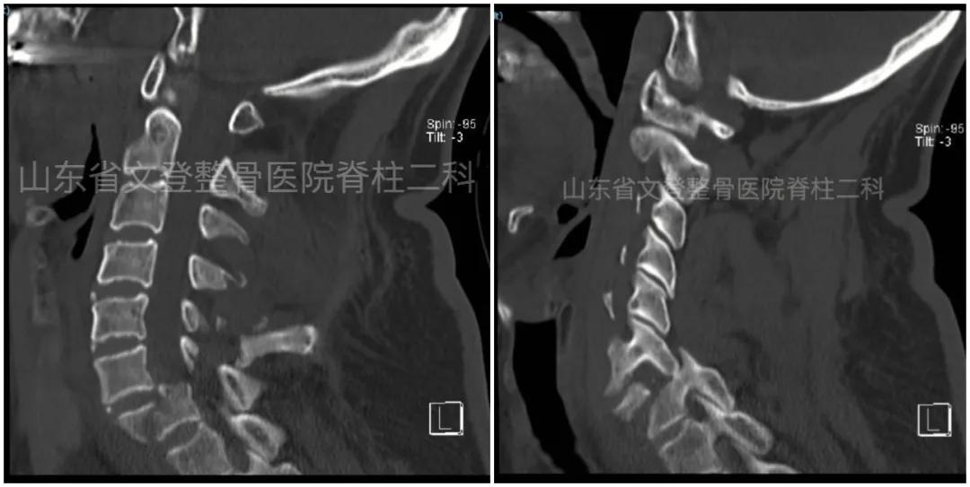 文登整骨医院治疗截瘫,山东文登整骨医院治疗怎么样
