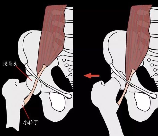 腿型矫正10天见效,腿型矫正动作