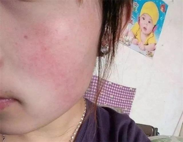 治疗激素脸敏感肌肤,激素脸屏障修护分享
