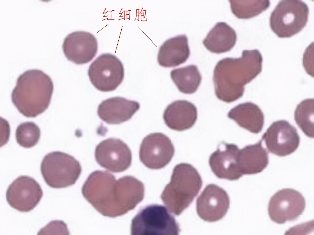 剧烈运动就尿血怎么回事呢,剧烈运动尿血要怎么缓解