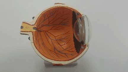 50岁男子用头顶了个球，晶状体脱位，悲剧了