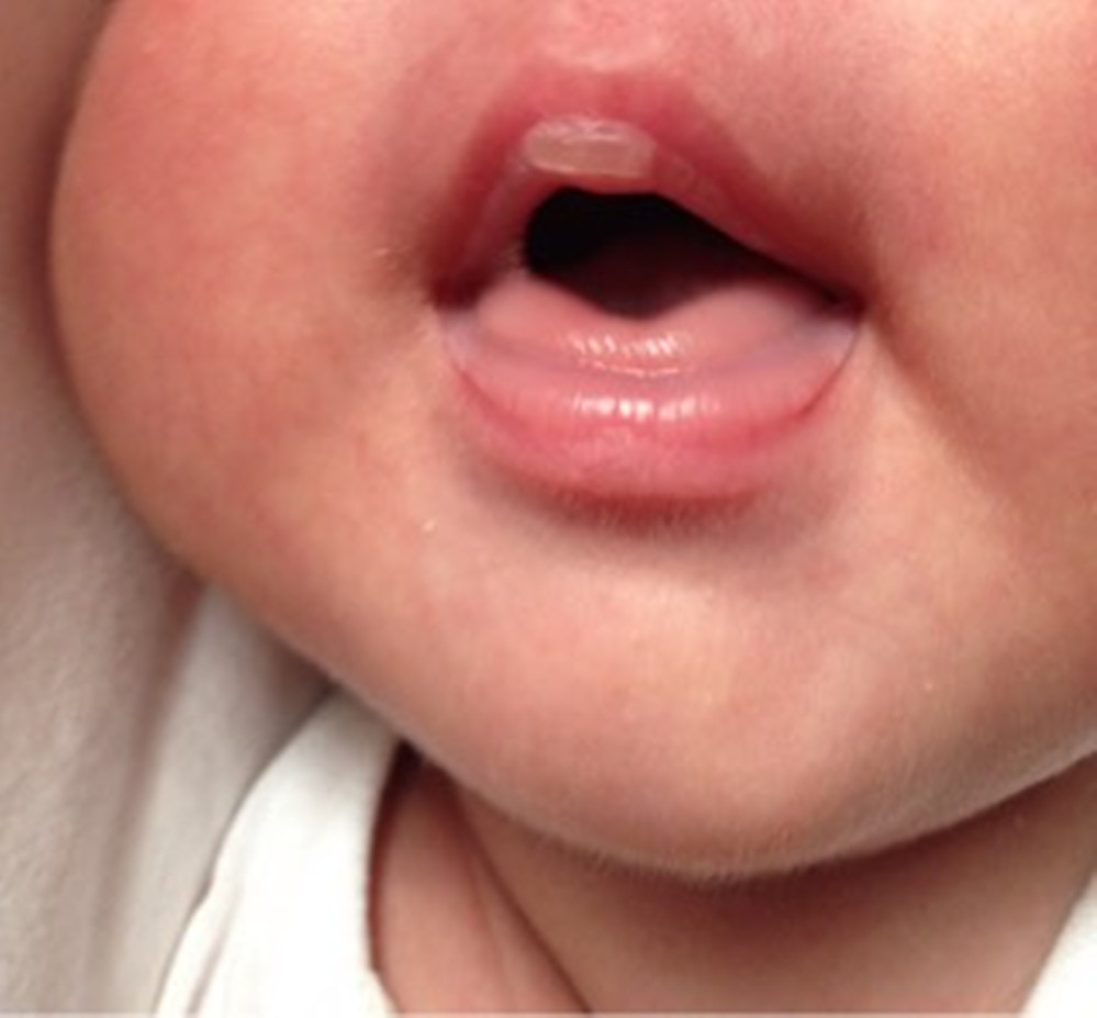 新生儿嘴唇上的奶泡多久可以脱落,新生儿上下嘴唇都有奶泡怎么办