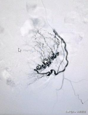 她因为子宫肌瘤贫血，差点切除子宫！还好新型疗法帮了她