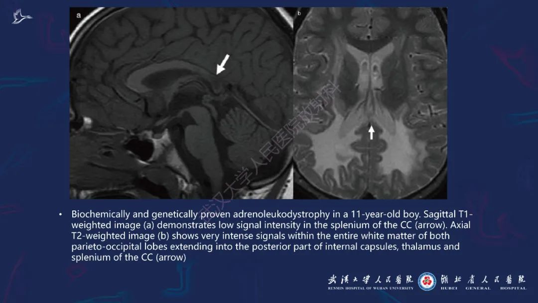 胼胝体肿瘤影像鉴别,胼胝体病变影像诊断