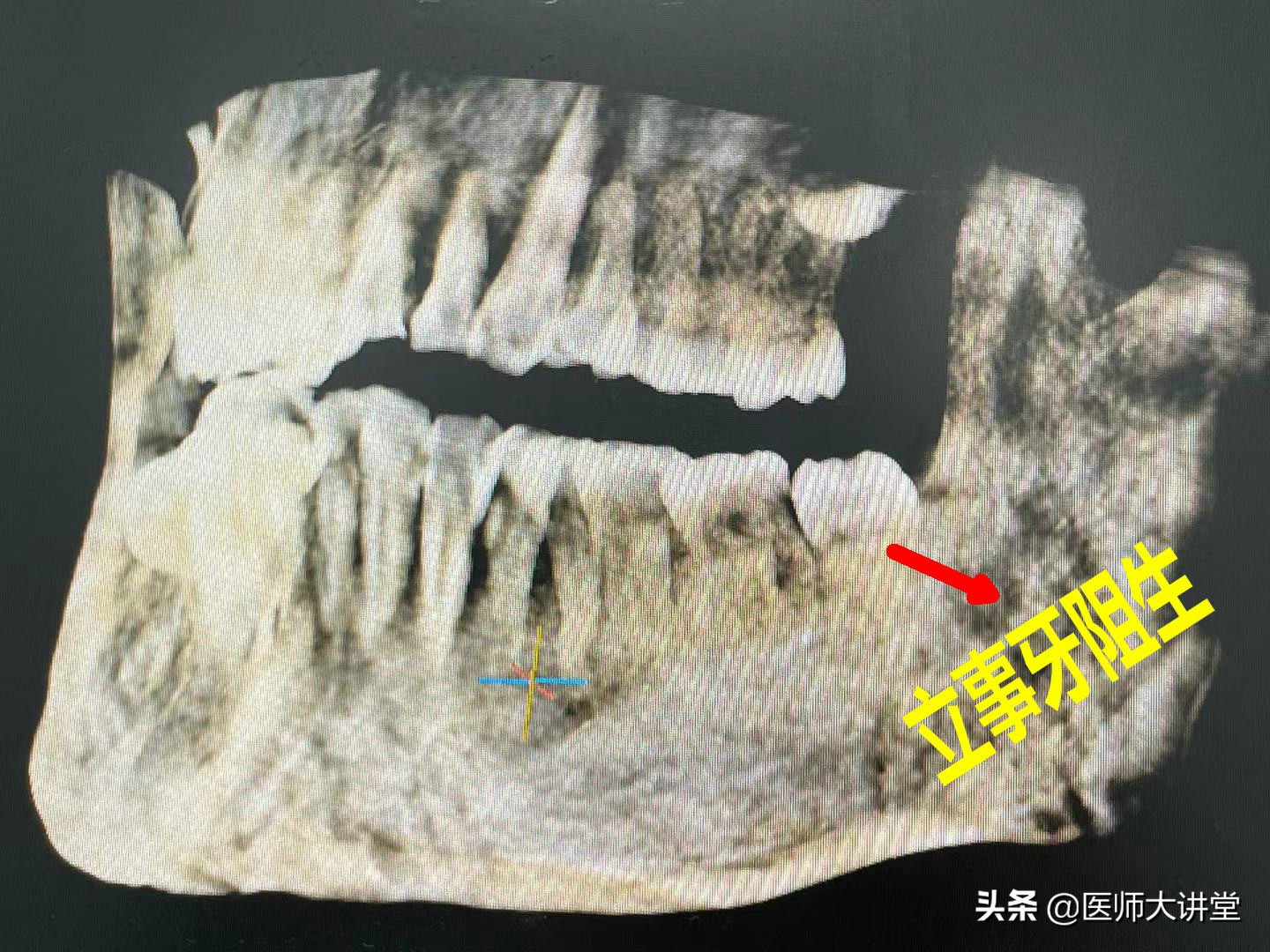 探讨56岁刘大姐拔除立事牙15天后疼痛肿胀的原因分析