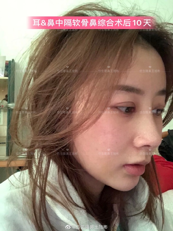 假体隆鼻耳软骨垫鼻尖图片,l型假体耳软骨隆鼻图片