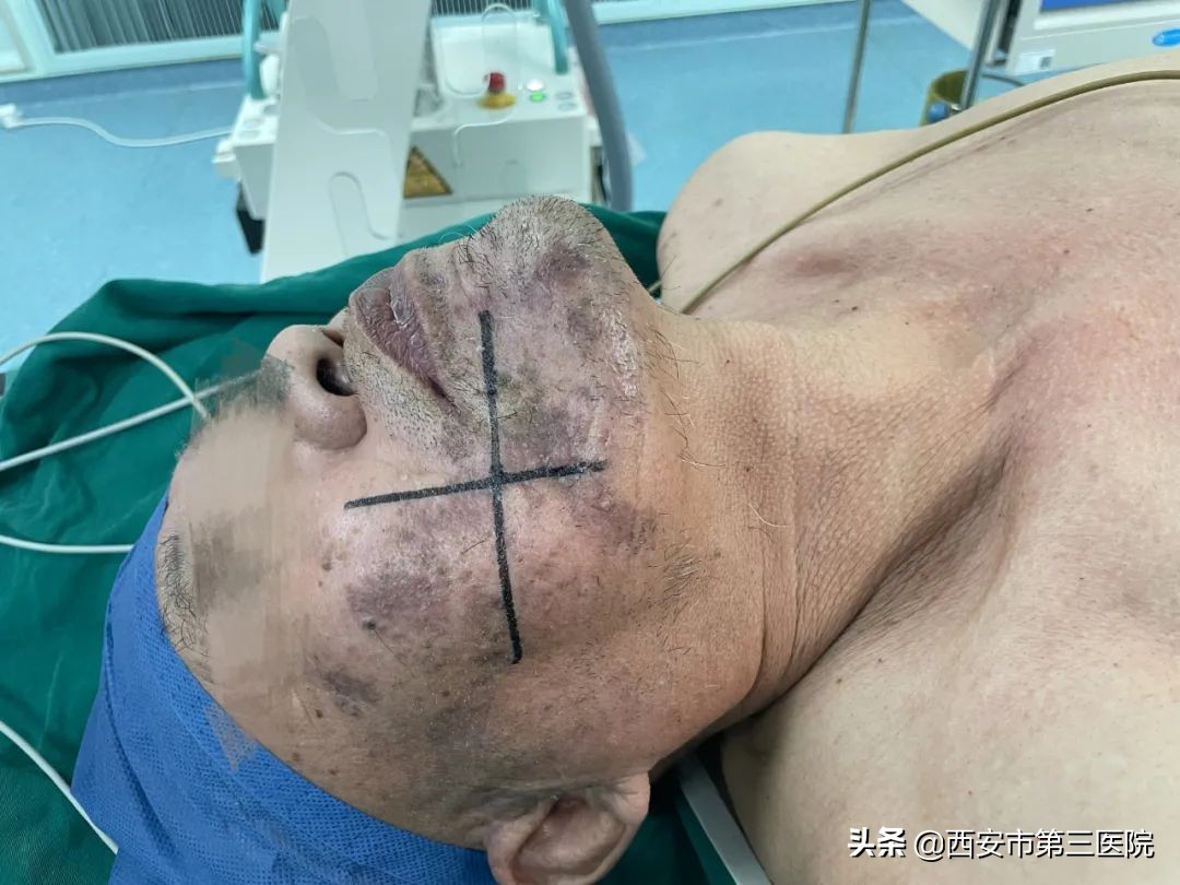 射频消融治疱疹神经疼多久康复,带状疱疹后遗神经痛消融术