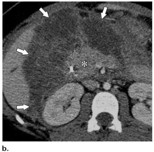 急性胰腺炎影像检查首选,急性坏死胰腺炎影像