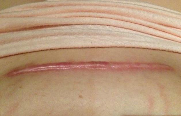 女性在剖腹产后常做这3件事，可能会让“刀口”变浅，别不知道了