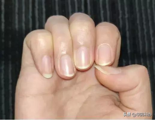 指甲上没月牙有横线长倒刺,关于指甲的科普指甲上的疾病视频
