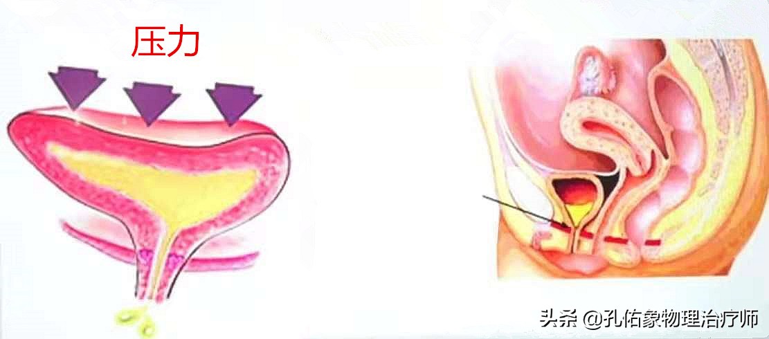 女性漏尿，究竟是怎么导致的？要如何治疗？一文给您详细解答