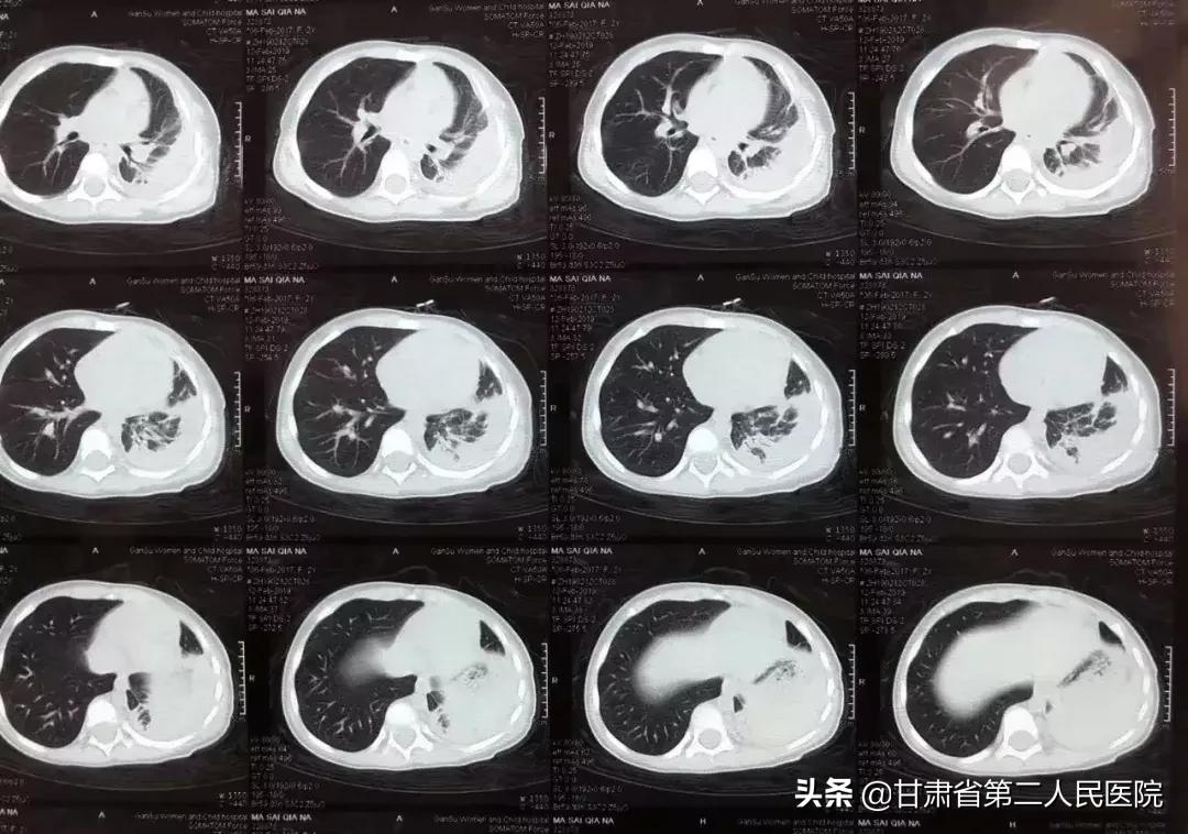 呼吸内科住院手术,呼吸内科手术