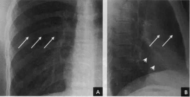 详细的胸部X线解剖，最基础最实用！