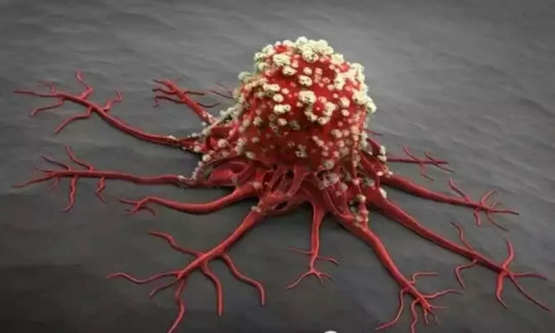 锥切病理1mm浸润癌会不会转移很快,浸润癌能彻底治好么