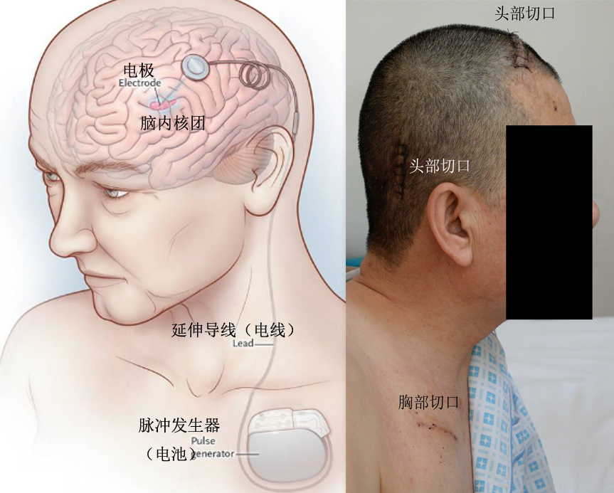 帕金森脑深部刺激手术后怎么恢复,脑深部电刺激能治愈帕金森吗