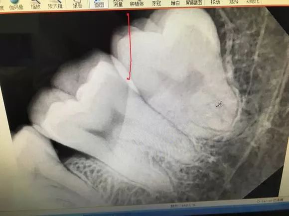 拔智齿是怎么算收费的,拔智齿是按智齿个数收费吗