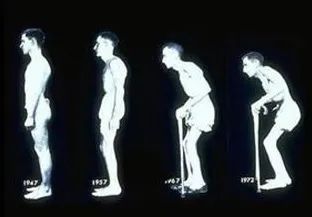 腰一侧腰痛要警惕四种病,我的腰怎么了