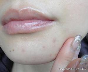 痘印顽固怎么消除医美,鼻子上顽固痘印可以用激光祛除吗