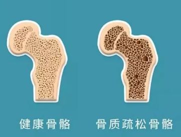 骨盐量多是好是坏,骨盐量多好还是少好