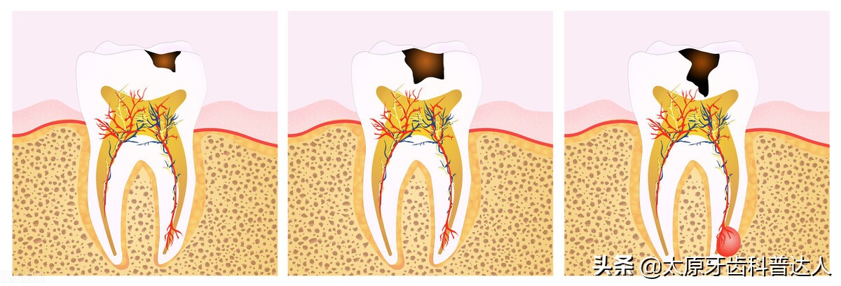 牙齿变黑到底是怎么回事,孩子牙齿变黑怎么回事