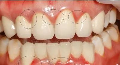 智齿一定要拔吗有风险,智齿一定要拔吗什么是智齿