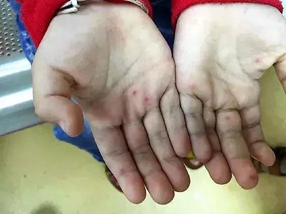 这一步才是治疗疱疹性咽峡炎的关键！做好预防和护理注意3件事