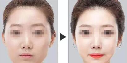 人中长颧骨高适合什么发型,人中长太阳穴凹陷