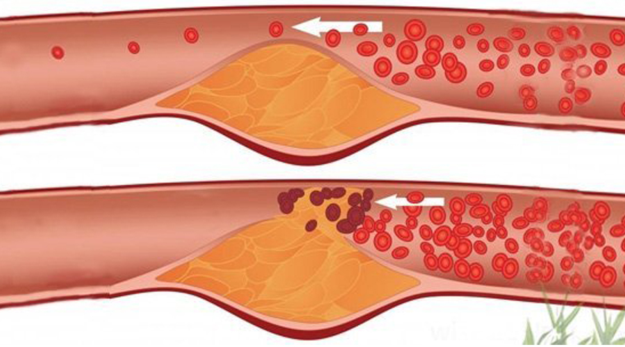 清理血管的最好的方法是什么,教你四个方法疏通血管不花钱