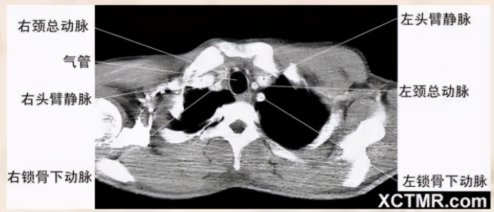 女性盆腔ct断层解剖结构图,女性盆腔脏器ct解剖