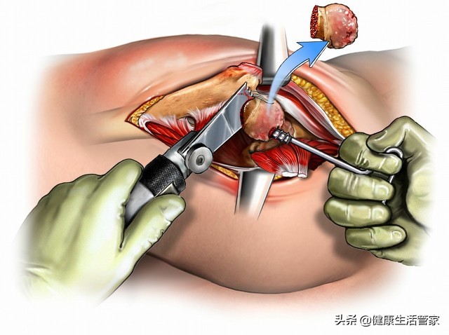 治疗股骨头坏死的中成药,董氏奇穴治疗股骨头坏死