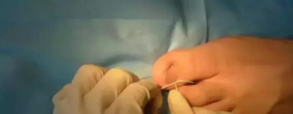 治疗甲沟炎真正有效的办法,甲沟炎指甲剪神器正品