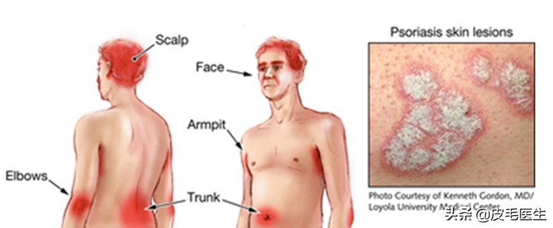 全身痒掉皮屑有什么征兆,浑身瘙痒发红是过敏了吗