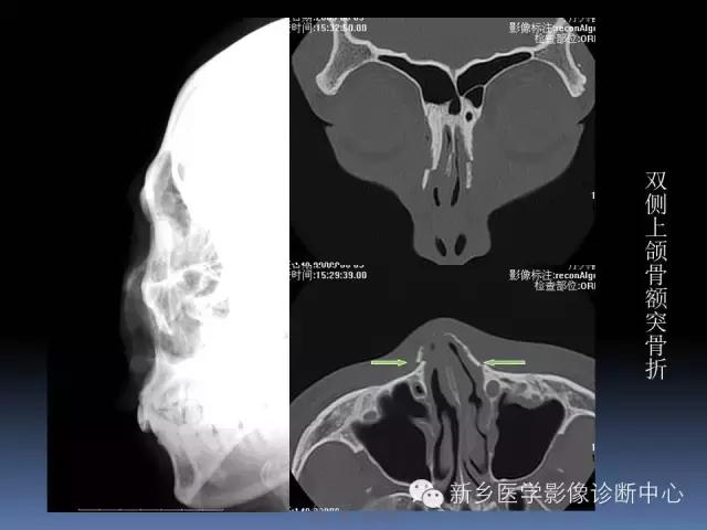 鼻骨骨折在ct片上的表现,鼻骨骨折ct怎么看