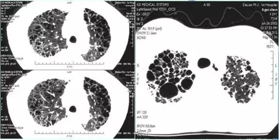 肺部ct十大征象,肺部ct正常图和异常图的区别