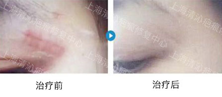 什么情况会让疤痕加重,不知道为啥现在成了疤痕体质