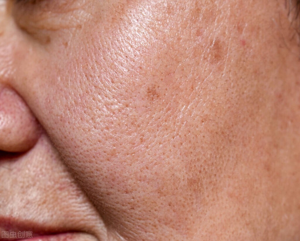 怎么改善缺水型毛孔,缺水型毛孔粗大真实有效解决方法