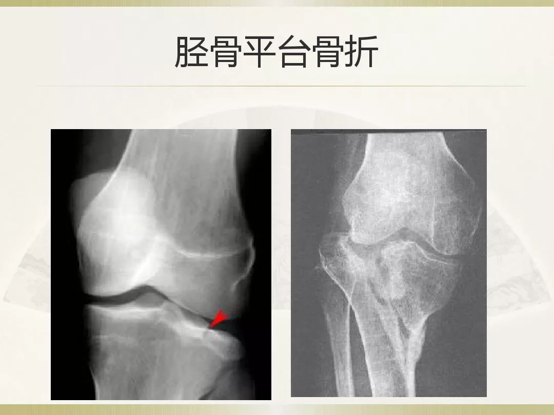 骨科x光片读片技巧,放射科骨科读片教程