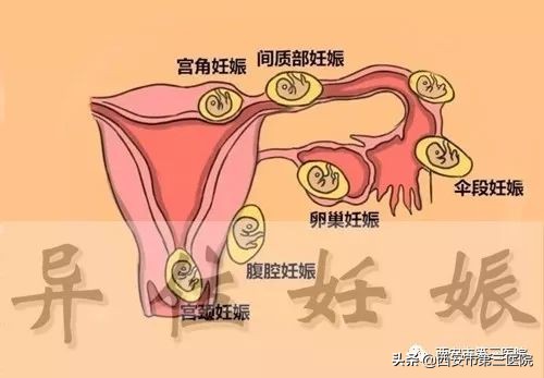 异位妊娠孕卵最易着床在哪里,异位妊娠后最易着床部位