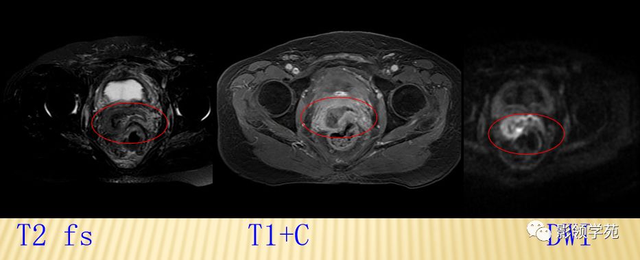 宫颈癌mri诊断,宫颈癌的mr扫描技术