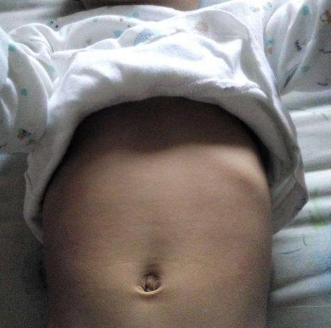 小孩脑袋凹进去一块,小孩头凹下去一圈