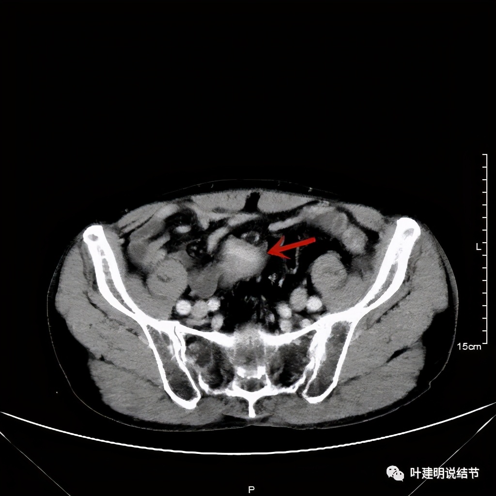 同时发现结肠癌和肺癌怎么处理,同时患结肠癌和直肠癌怎么办